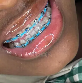 Fashion Braces