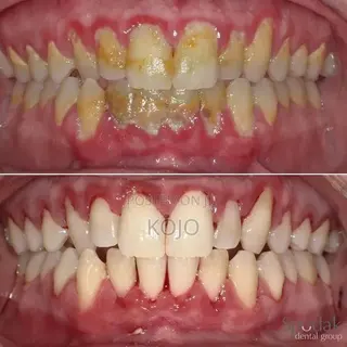 Teeth Cleaning