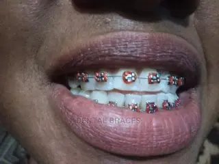 Get Fashion Brace Smile Good