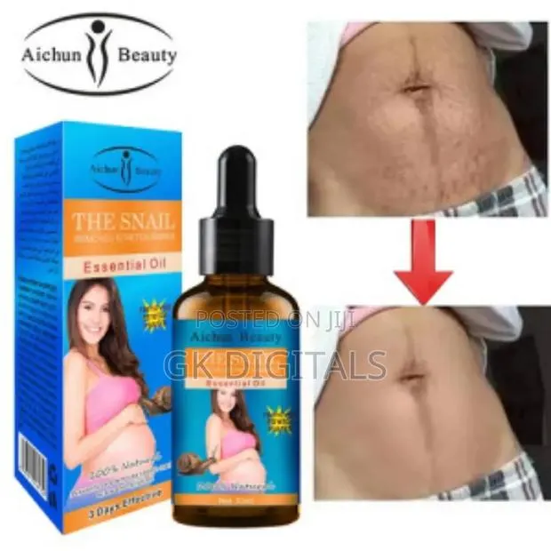 Stretch Marks Removal in a Few Week · Photo 1