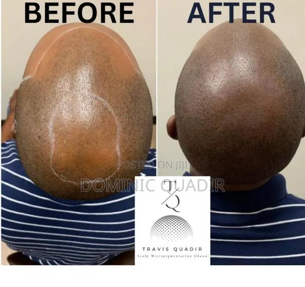 Scalp Micropigmentation · Photo 1