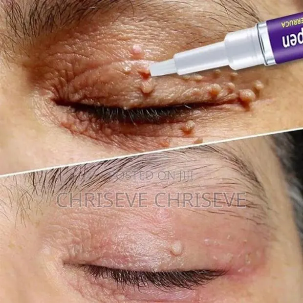 Super Active Skin Wart Remover · Photo 1