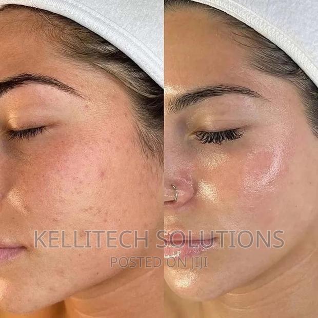 Derma Roller (0.5mm, 540needles) Promo · Photo 2