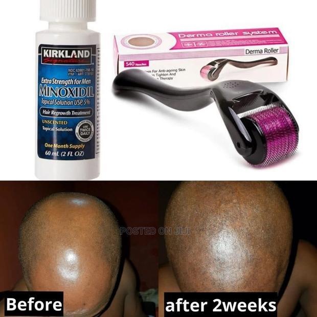 Kirkland Minoxidil and Derma Roller Combo for Hair Growth · Photo 1