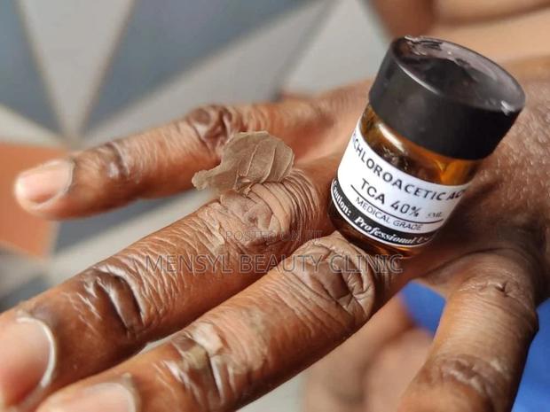 Tca Chemical Peel Solution · Photo 3