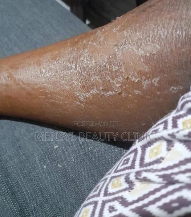Tca Chemical Peel Solution · Photo 4