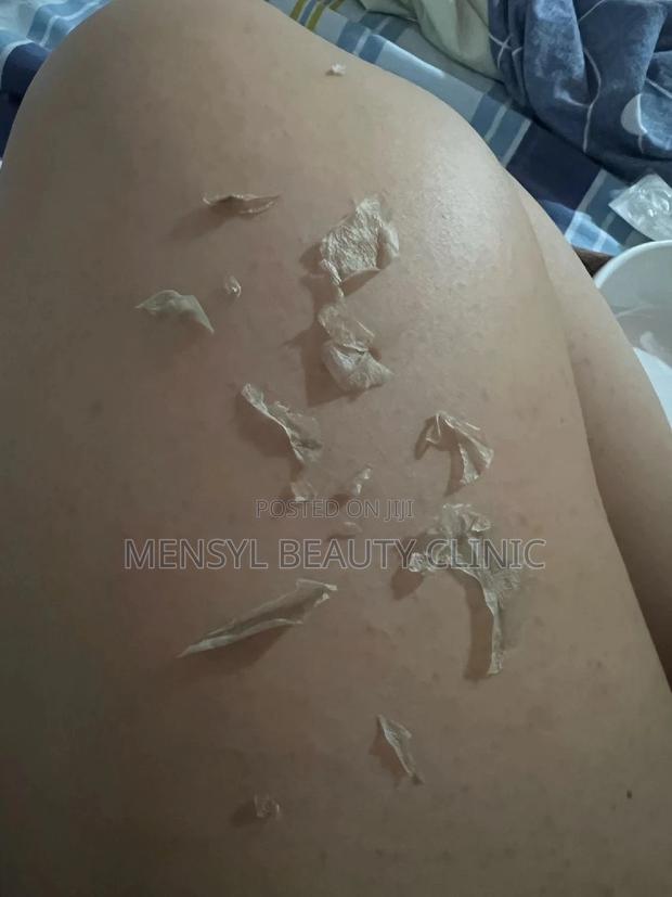 Tca Chemical Peel Solution · Photo 6
