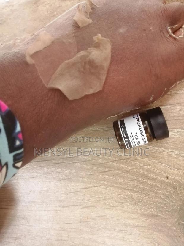 Tca Chemical Peel Solution · Photo 5