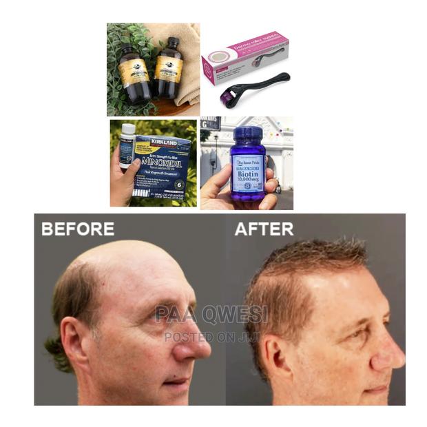 Jaimaca Castor Oil,Biotin,Derma Roller Kirkland{Utra} · Photo 1