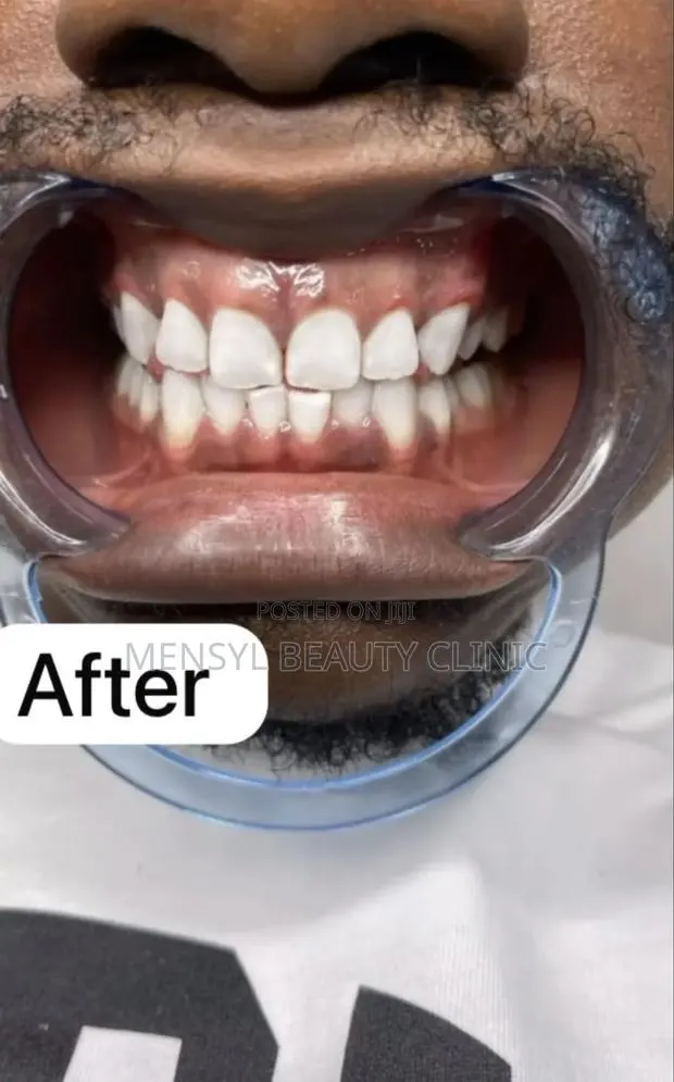 Professional Teeth Whitening · Photo 2