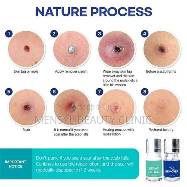 Medical Grade Skin Tag, Genital Wart and Mole Removal 2 in 1 · Photo 2