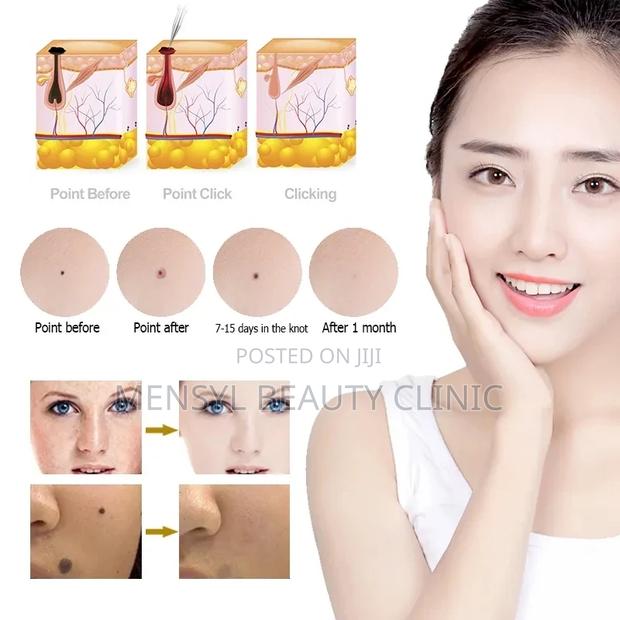 Plasma Pen for Skin Tag Removal,Stretch Marks and Tightening · Photo 3