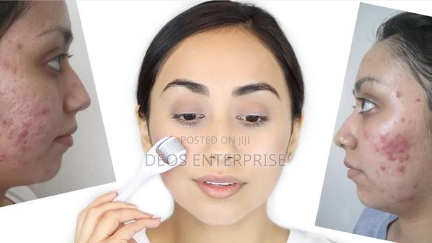 Derma Roller for Treating Scalps · Photo 1