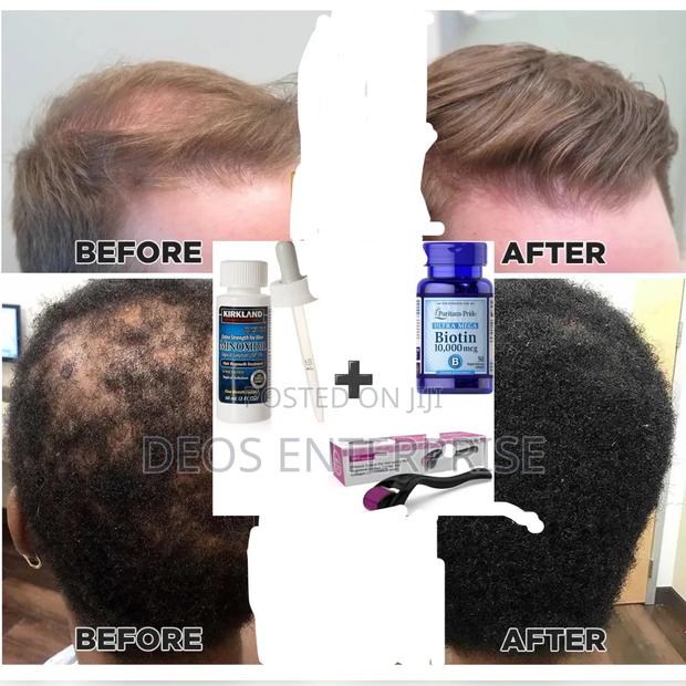 Recommended Super Combo for Beard and Hair Growth · Photo 1