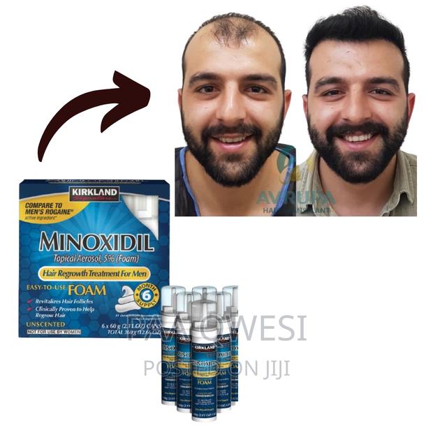 Kirkland Foam ( Hair Regrowth Treatment for Men · Photo 1