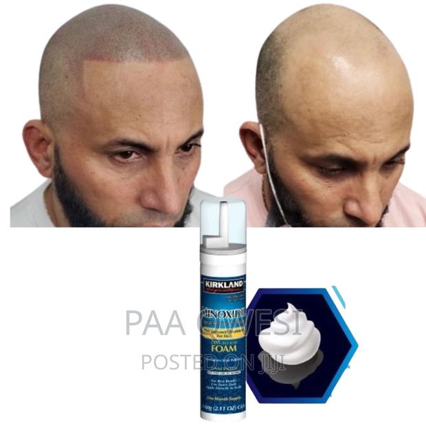 Super Fast Hairline Regrowth · Photo 1