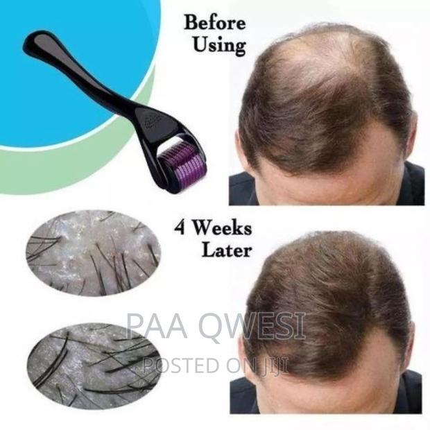 Derma Roller ( 1.5 Mm ) for Hair Scalp · Photo 1
