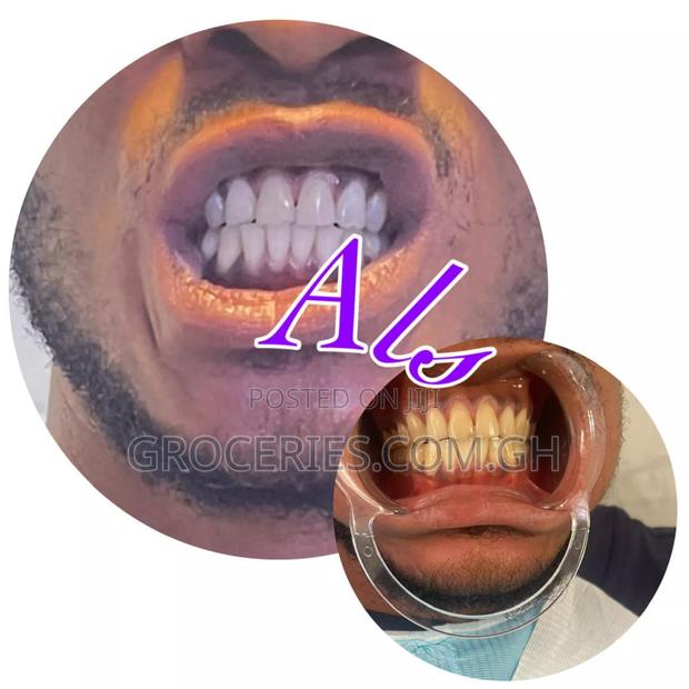 Laser Teeth Whitening · Photo 1