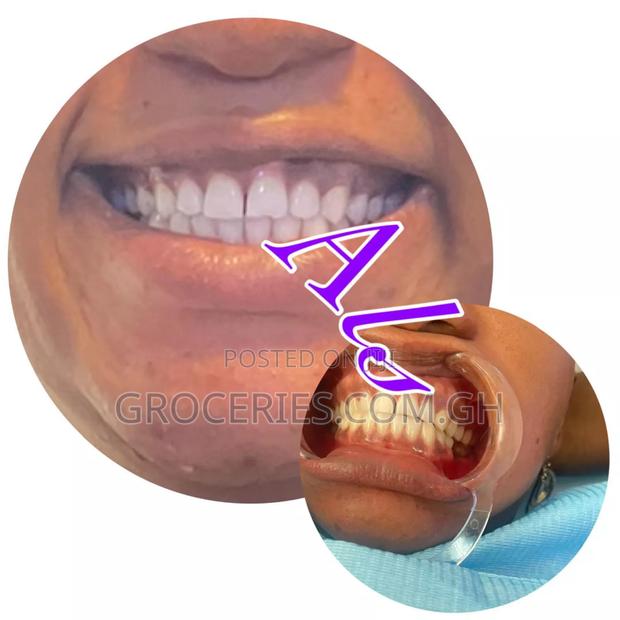 Laser Teeth Whitening · Photo 2