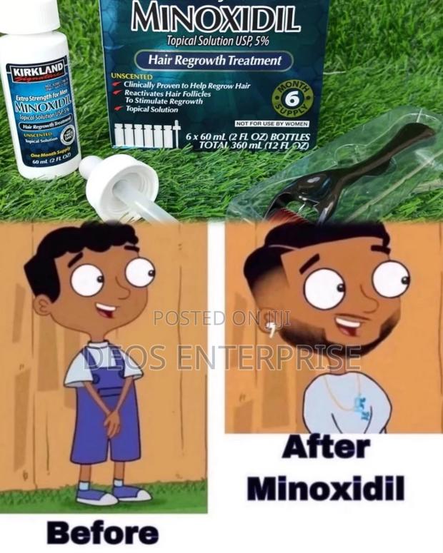 Kirkland Minoxidil Derma Roller Beard and Baldness Growth · Photo 1