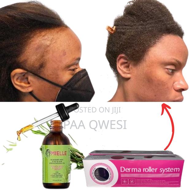 {Mielle Derma Roller} Super Hairline Loss Regrowth · Photo 1