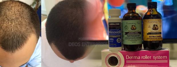 Great Product for Baldness Growth · Photo 1