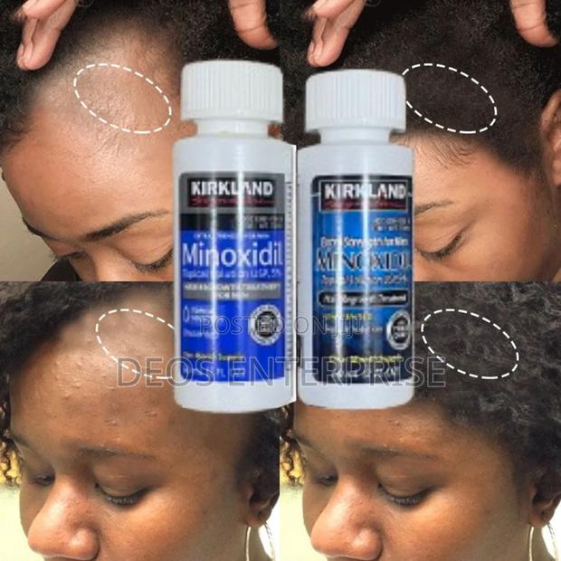 Two Kirkland Minoxidil for Hair Growth for Sale · Photo 1