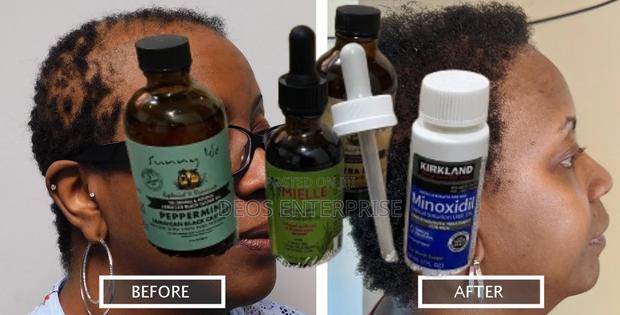 Affordable Quality Hair Loss Growth Products · Photo 1