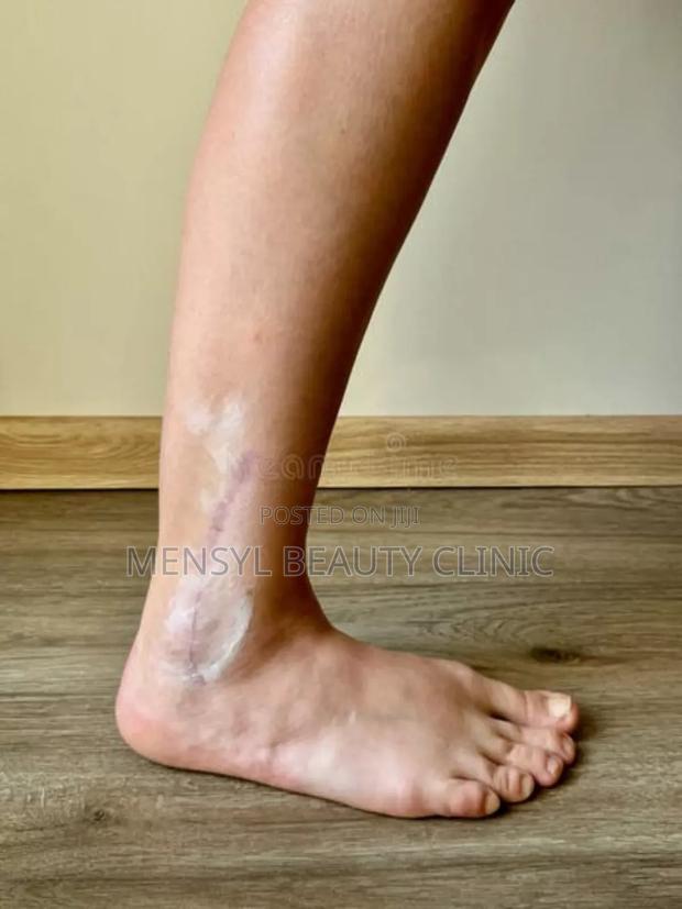 Silicone Scar Gel for All Type of Scar Including Keloid · Photo 4
