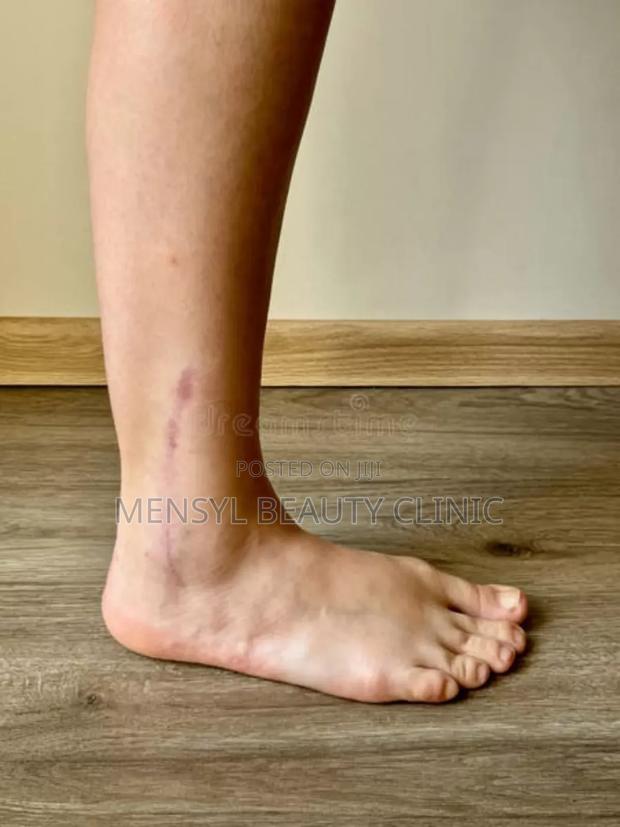 Silicone Scar Gel for All Type of Scar Including Keloid · Photo 5
