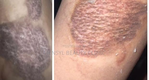 Silicone Scar Gel for All Type of Scar Including Keloid · Photo 2