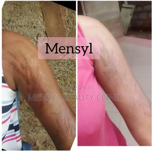 Stretch Marks Removal Therapy at Mensyl Beauty Clinic · Photo 1