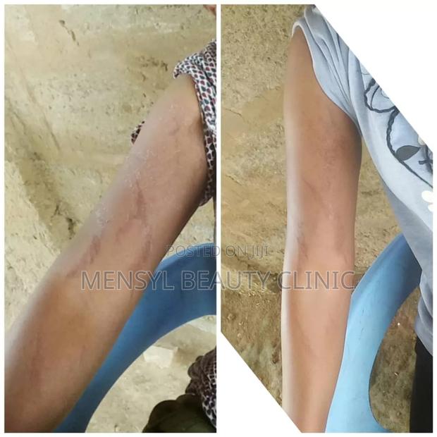 Stretch Marks Removal Therapy at Mensyl Beauty Clinic · Photo 2