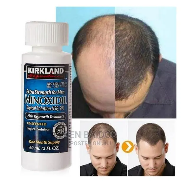 Kirkland Hair Regrowth (Treat Baldness) · Photo 1