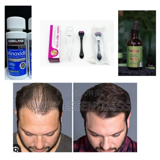 Bald Spots Patchy Beard Solution · Photo 1