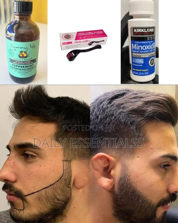 Kirkland Minoxidil + Peppermint + Derma Roller Kit · Photo 1