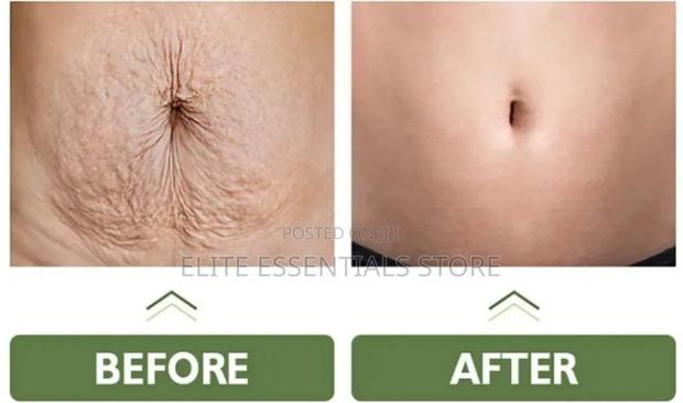 Tummy Tuck Stretch Marks Removal Skin Tightening Cream · Photo 2