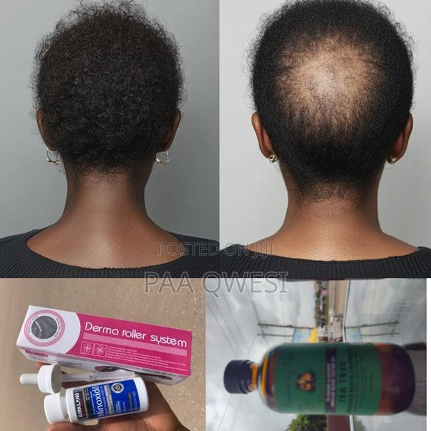 3 in 1 Hair Kit: Kirkland, Castor Oil Roller · Photo 1