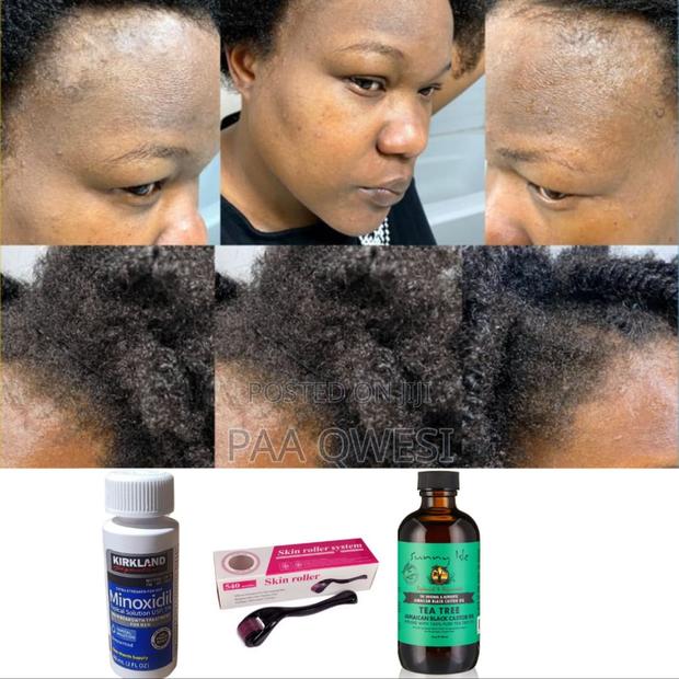 Effective Hair Growth- Use Sunny Isle Tea Tree W/Minoxidil · Photo 1