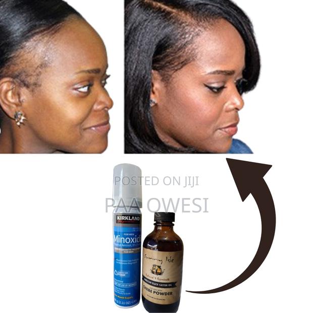 Kirkland Minoxidil Foam +Sunny Isle Chebe Powder · Photo 1