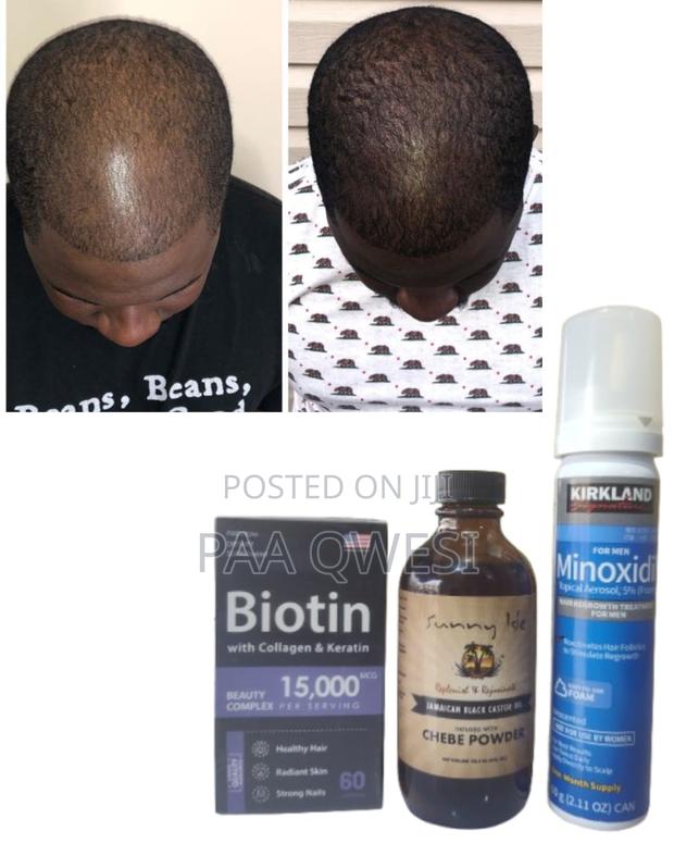 Biotin + Kirkland Foam+ Chebe Powder Oil Hair Growth Combo · Photo 1