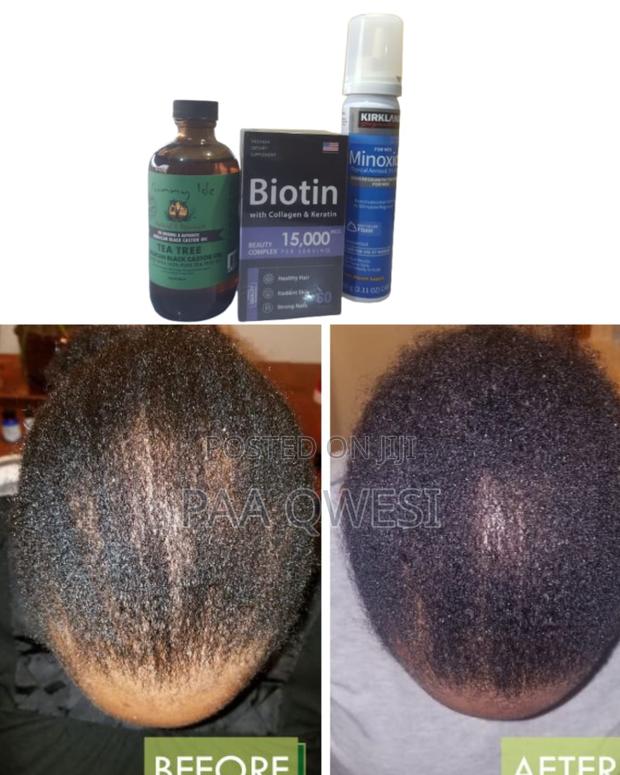 Stronger Hair Combo - Use Biotin + Kirkland Foam + Tea Tree · Photo 1