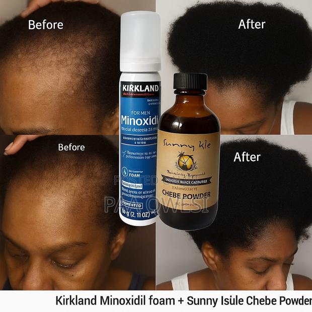 Chebe Powder + Kirkland Minoxidil Foam · Photo 1