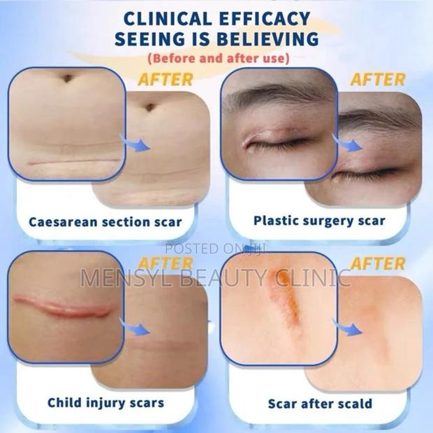 Dermatix Ultra Advanced Scar Gel Cutsburns,C-Section Keloid · Photo 4