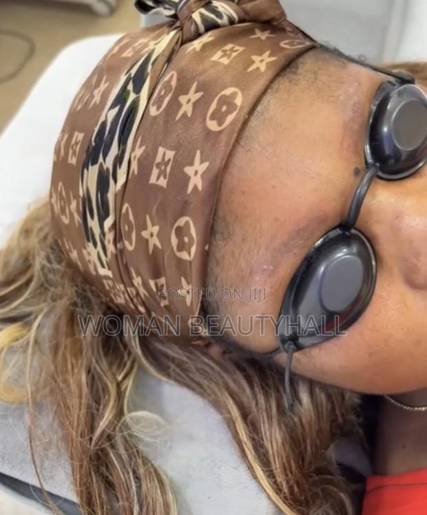 Laser Brows Removal · Photo 2