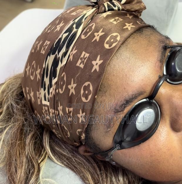 Laser Brows Removal · Photo 3