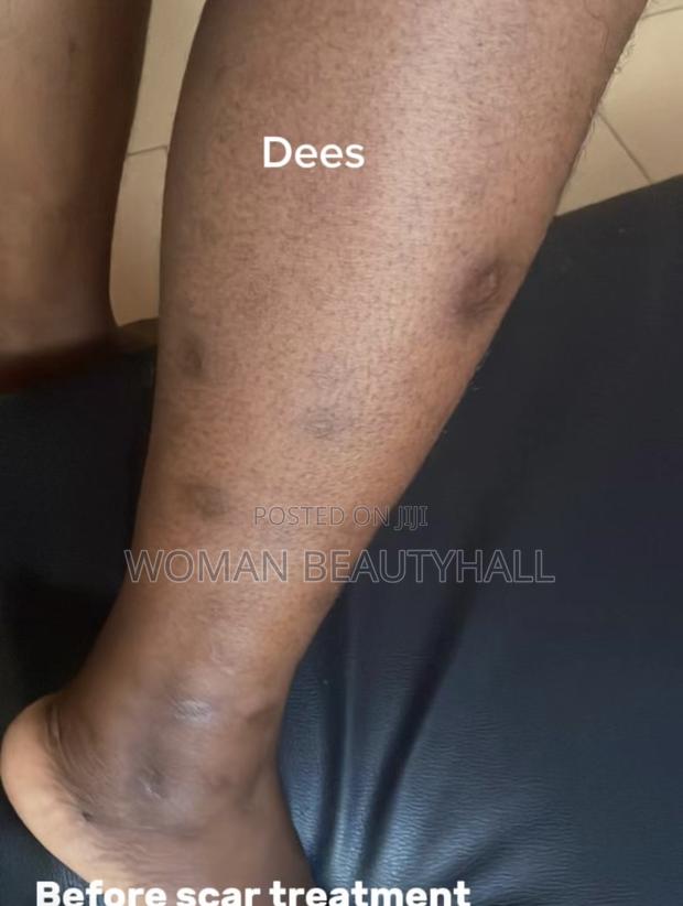 Advance Laser Scar Treatment · Photo 4