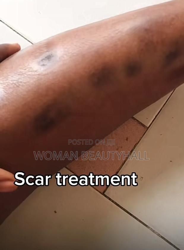 Advance Laser Scar Treatment · Photo 2