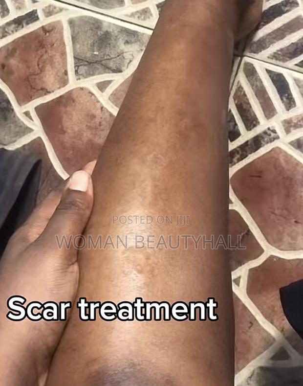 Advance Laser Scar Treatment · Photo 3