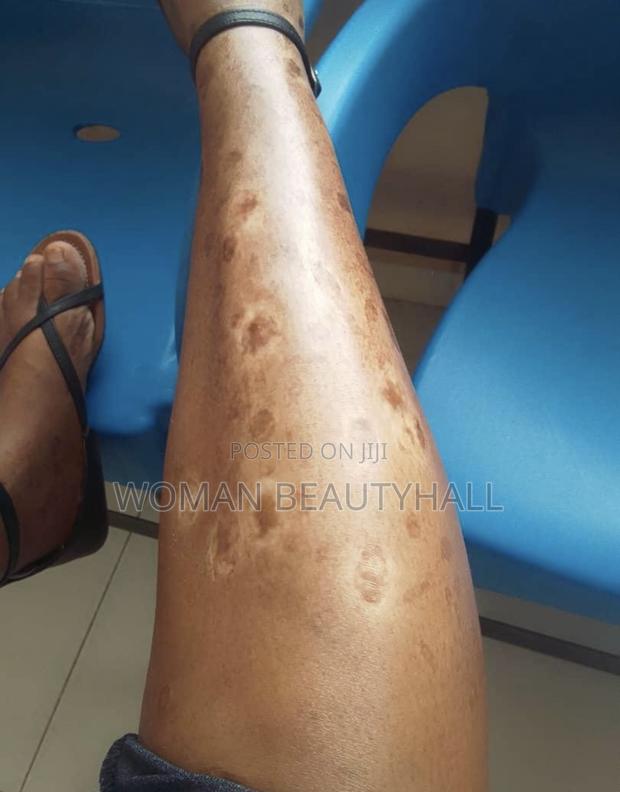 Advance Laser Scar Treatment · Photo 6